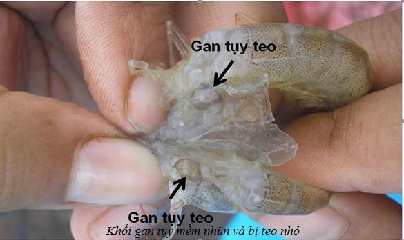 benh-gan-tren-tom-the-2